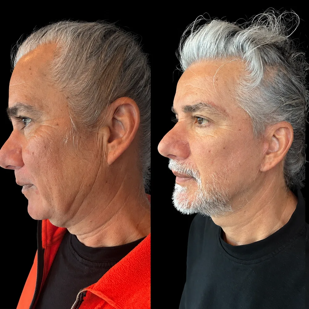 Face and neck lift, before and after, case 10, side view