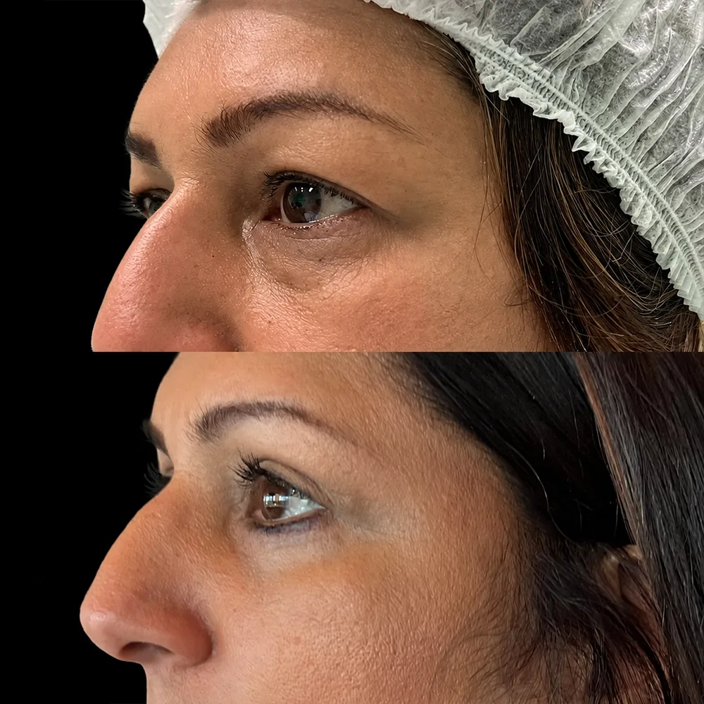 Eyelid surgery, before and after, case 07, side view