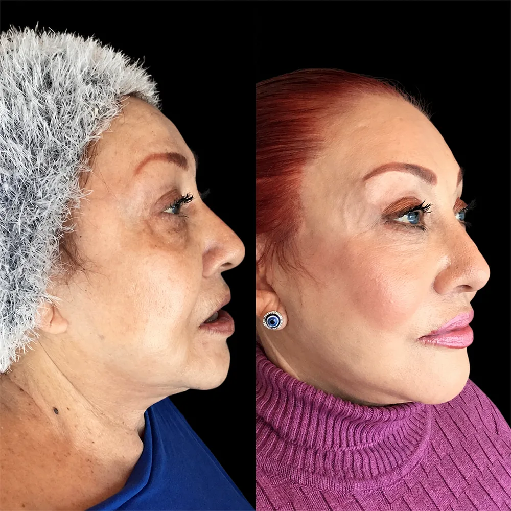 Face and neck lift, before and after, case 08, oblique view