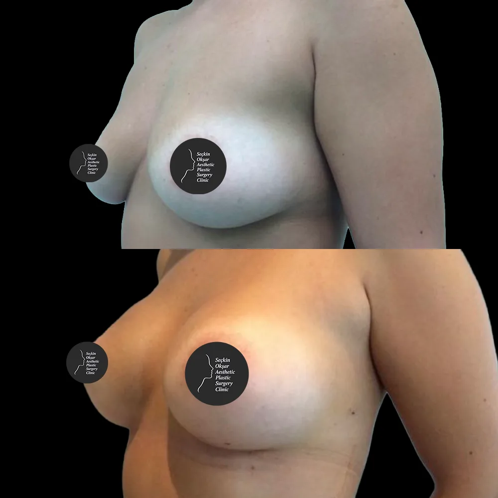 Breast augmentation, before and after, case 11, oblique view