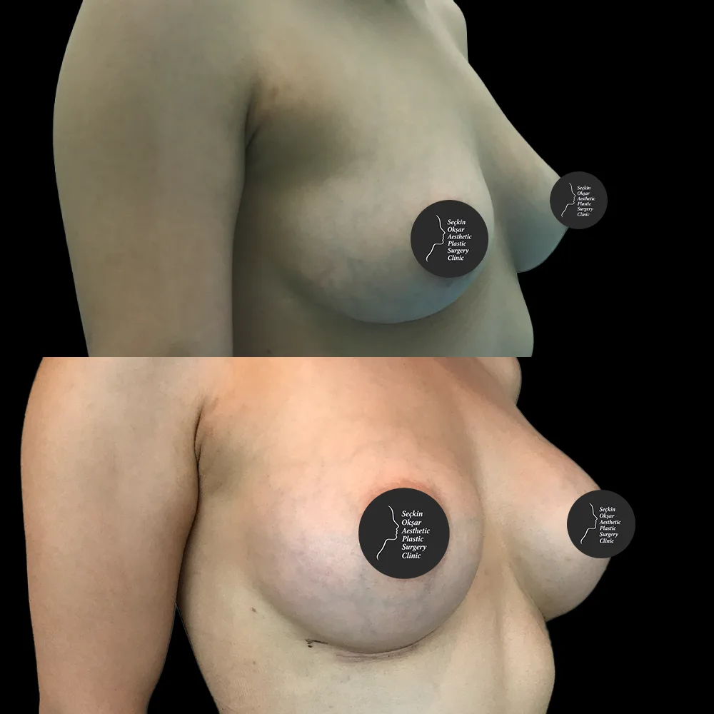 Breast augmentation, before and after, case 07, front view