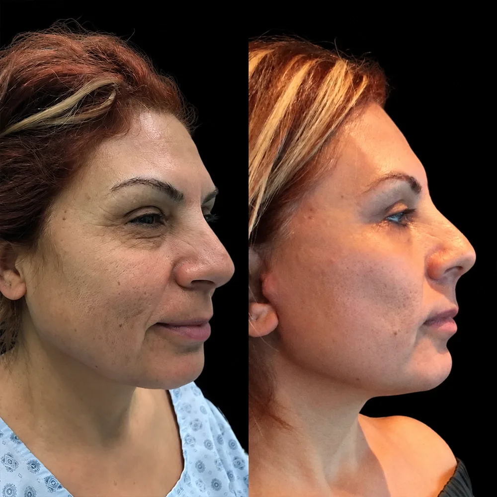 Face and neck lift, before and after