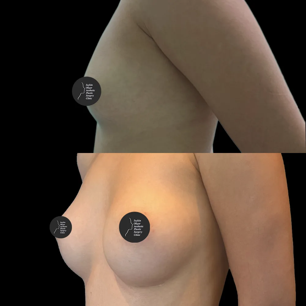 Breast surgery, before and after