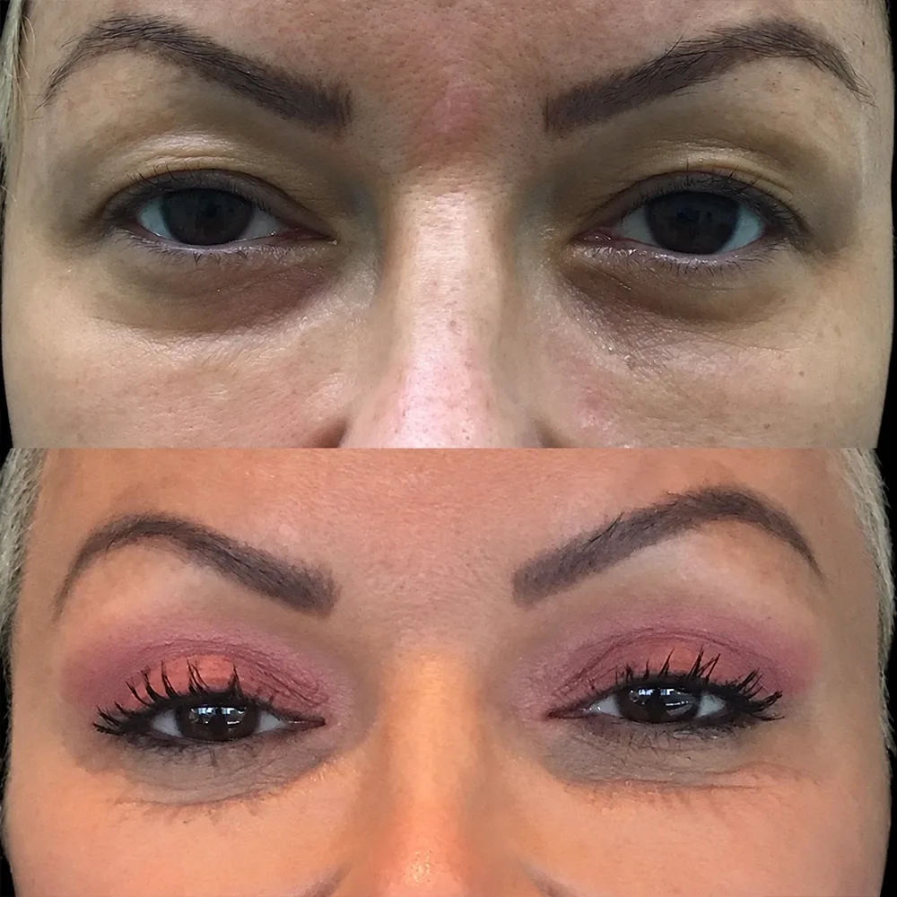 Eyelid surgery, before and after, case 02, front view