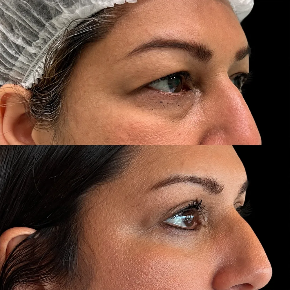 Eyelid surgery, before and after, case 07, oblique view
