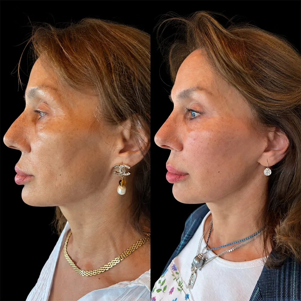 Face and neck lift, before and after, case 16, front view