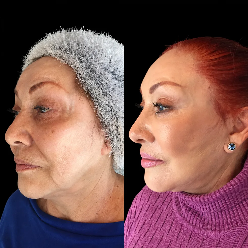Face and neck lift, before and after, case 08, side view