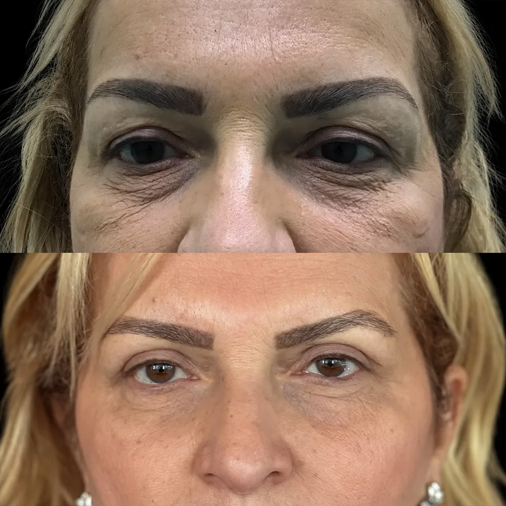 Eyelid surgery, before and after
