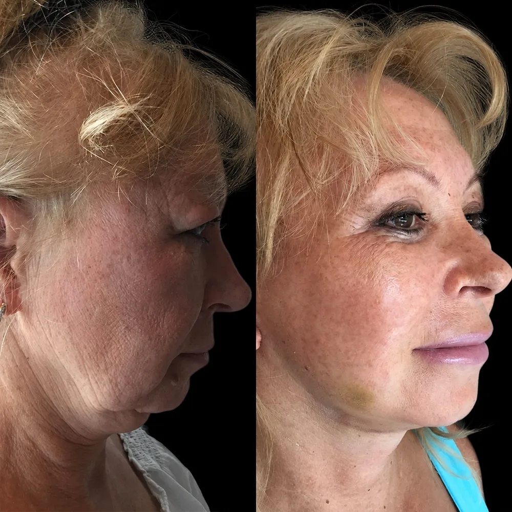 Face and neck lift, before and after