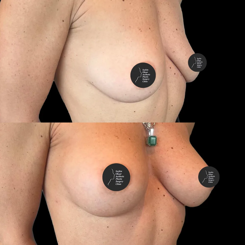 Breast augmentation, before and after, case 10, oblique view