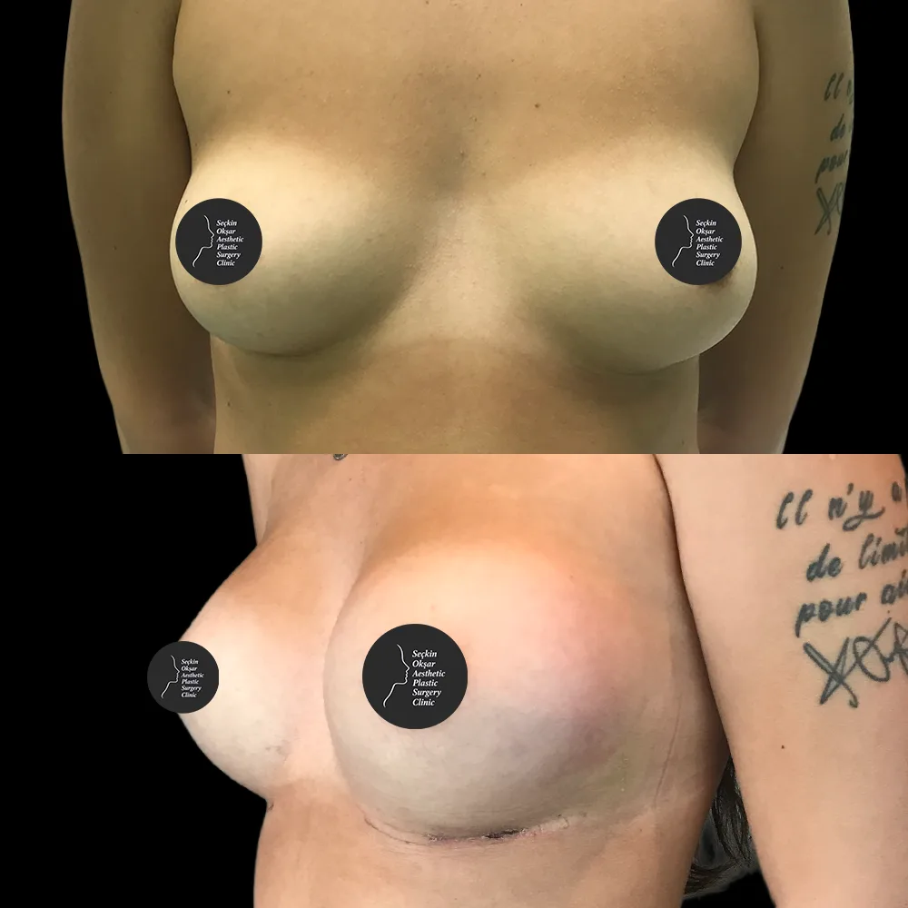Breast augmentation, before and after, case 05, side view