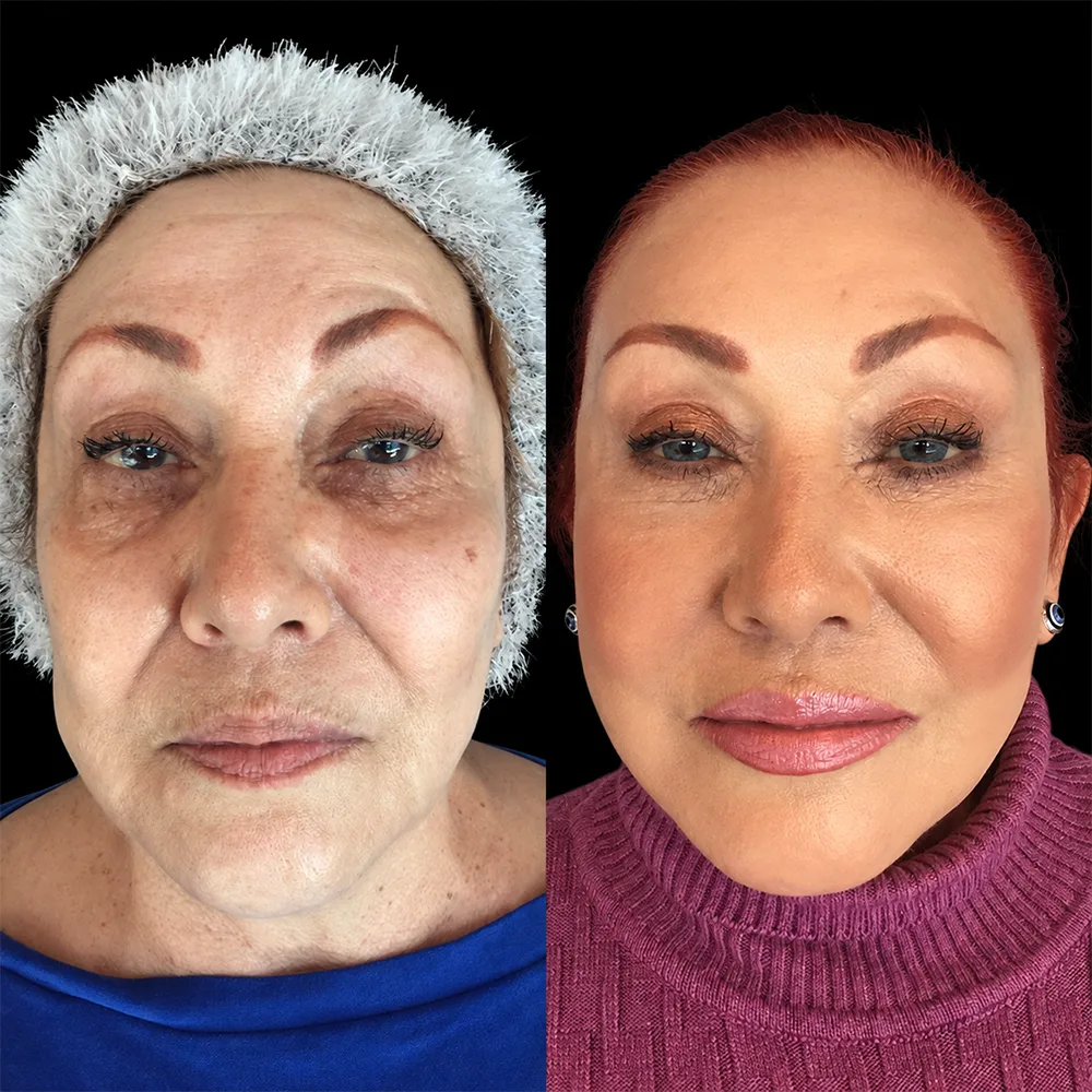 Face and neck lift, before and after, case 08, front view