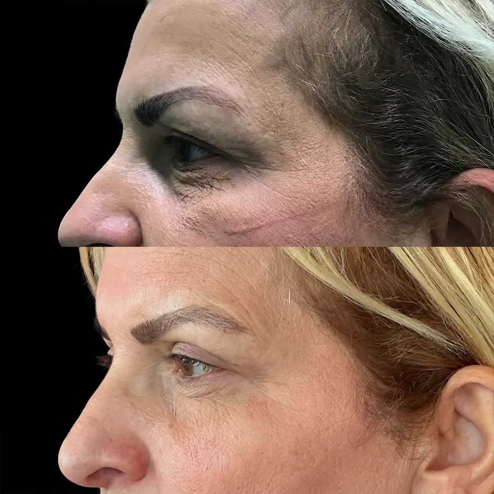 Eyelid surgery, before and after, case 10, oblique view