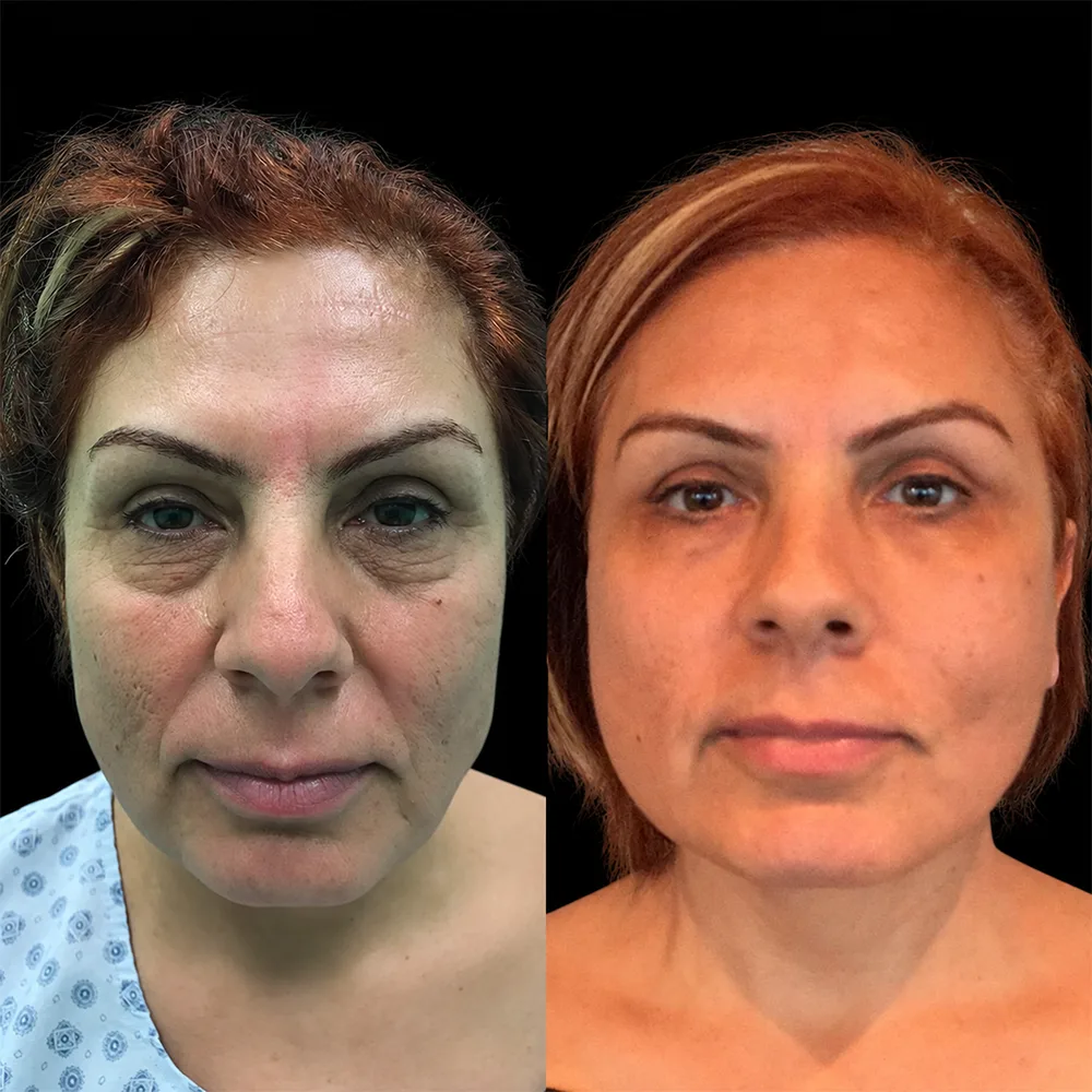 Face and neck lift, before and after, case 04, front view