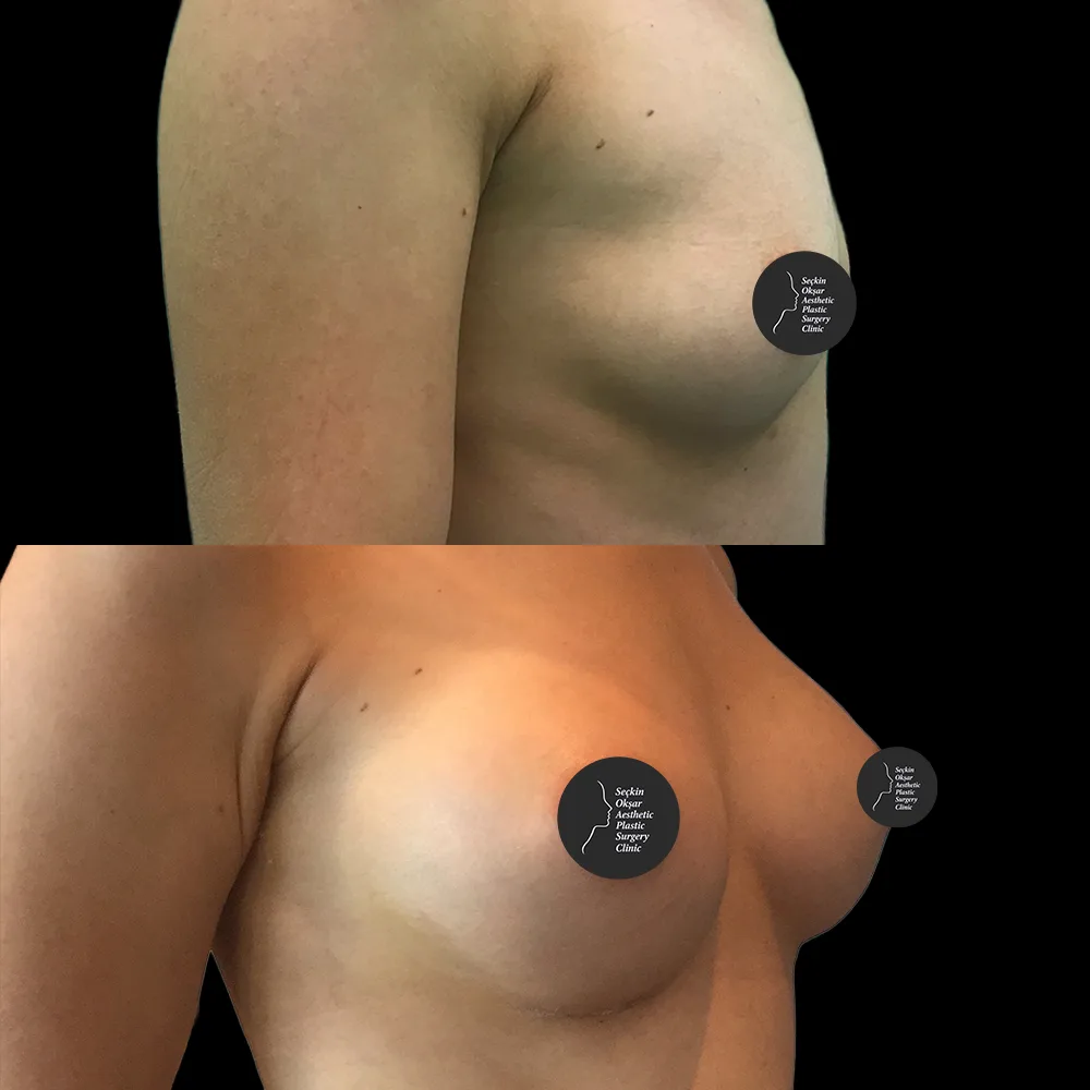 Breast augmentation, before and after, case 02, front view