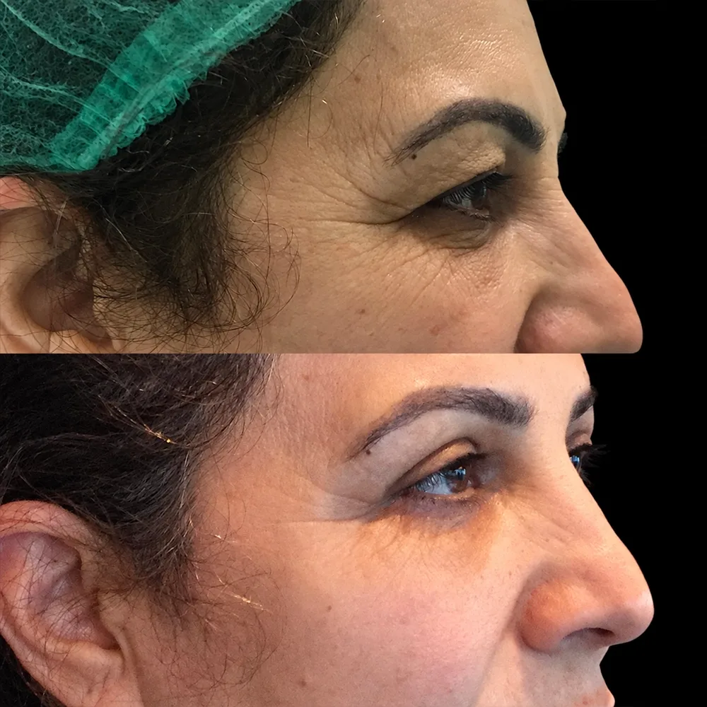 Eyelid surgery, before and after, case 09, oblique view