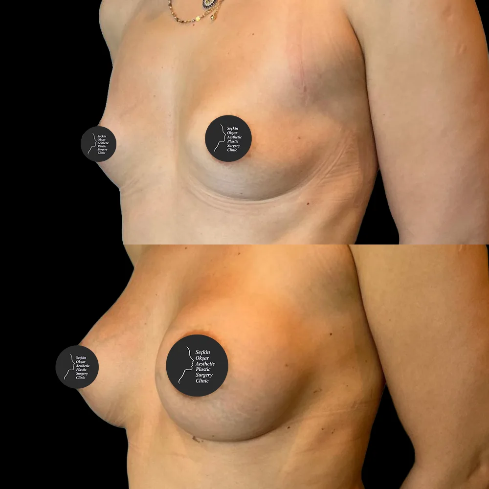 Breast augmentation, before and after