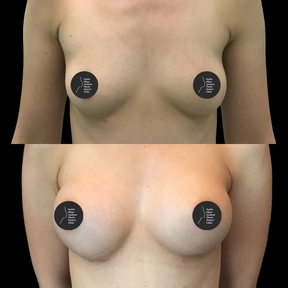 Breast augmentation, before and after, case 01, side view