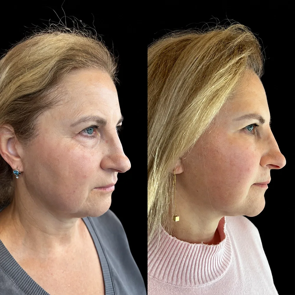 Face and neck lift, before and after, case 17, side view