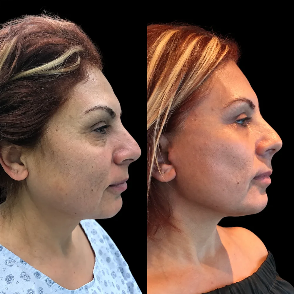 Face and neck lift, before and after, case 04, oblique view