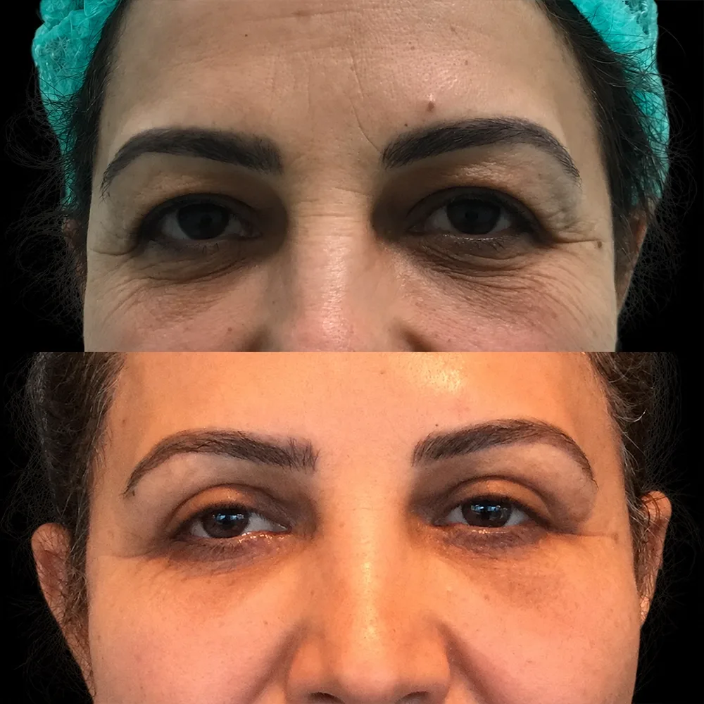 Eyelid surgery, before and after, case 09, front view