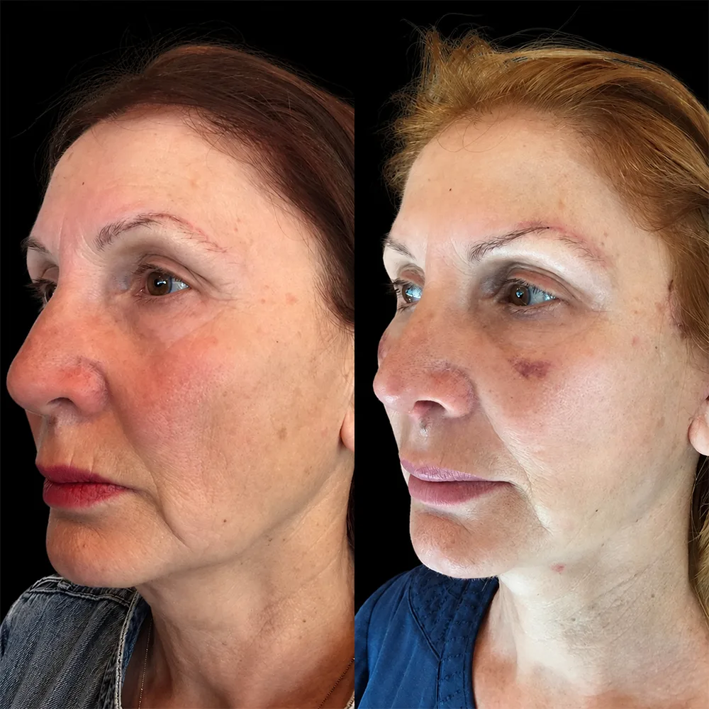 Face and neck lift, before and after, case 06, side view