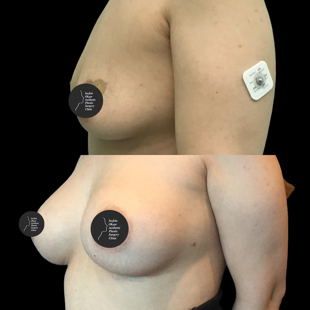 Breast augmentation, before and after, case 03, oblique view