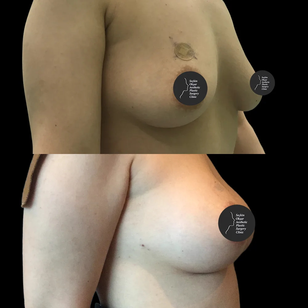 Breast augmentation, before and after, case 03, front view