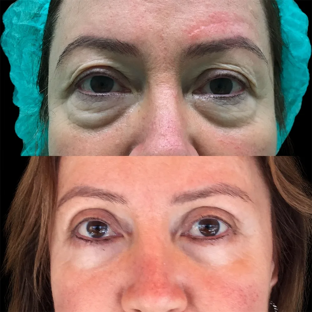 Eyelid surgery, before and after, case 03, front view