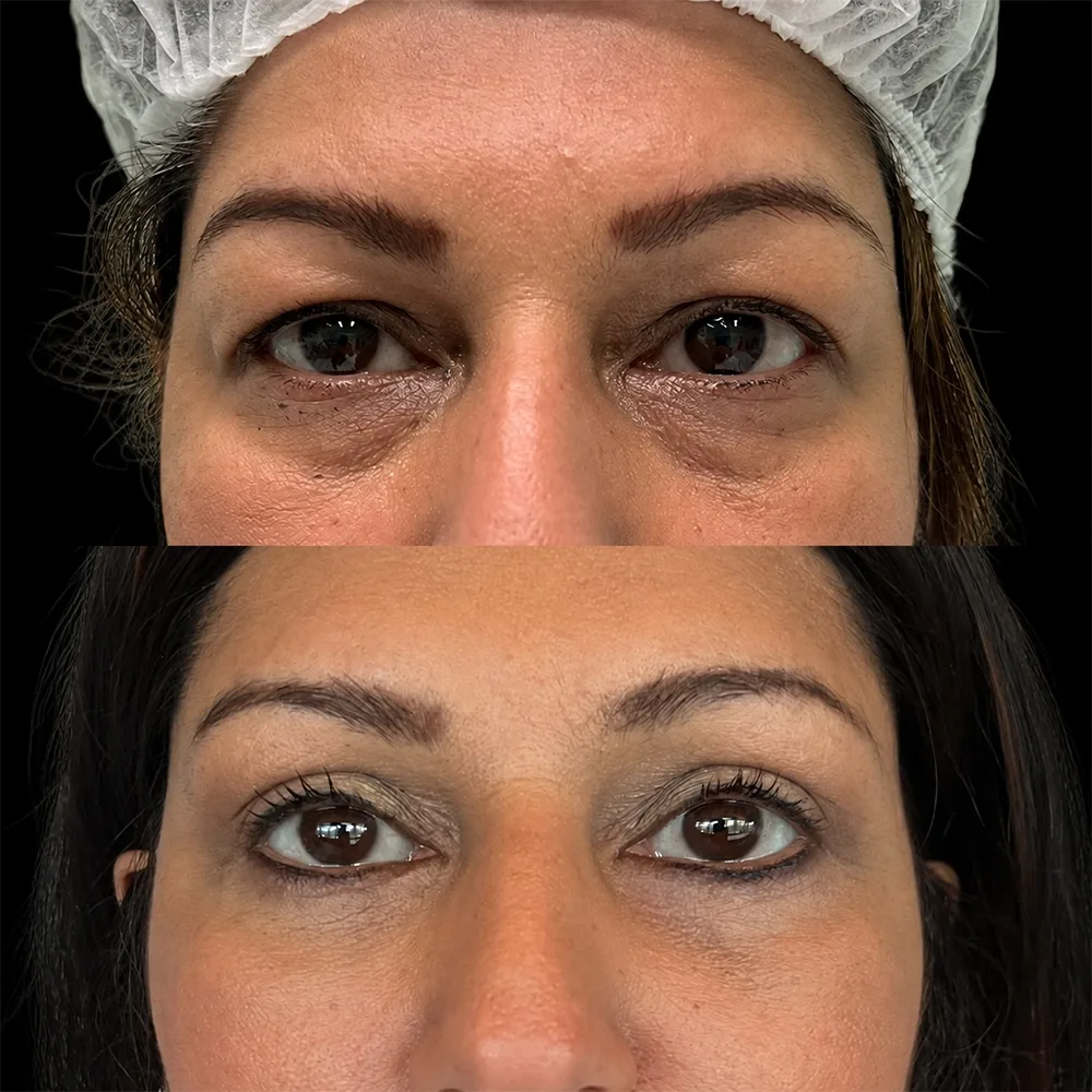 Eyelid surgery, before and after