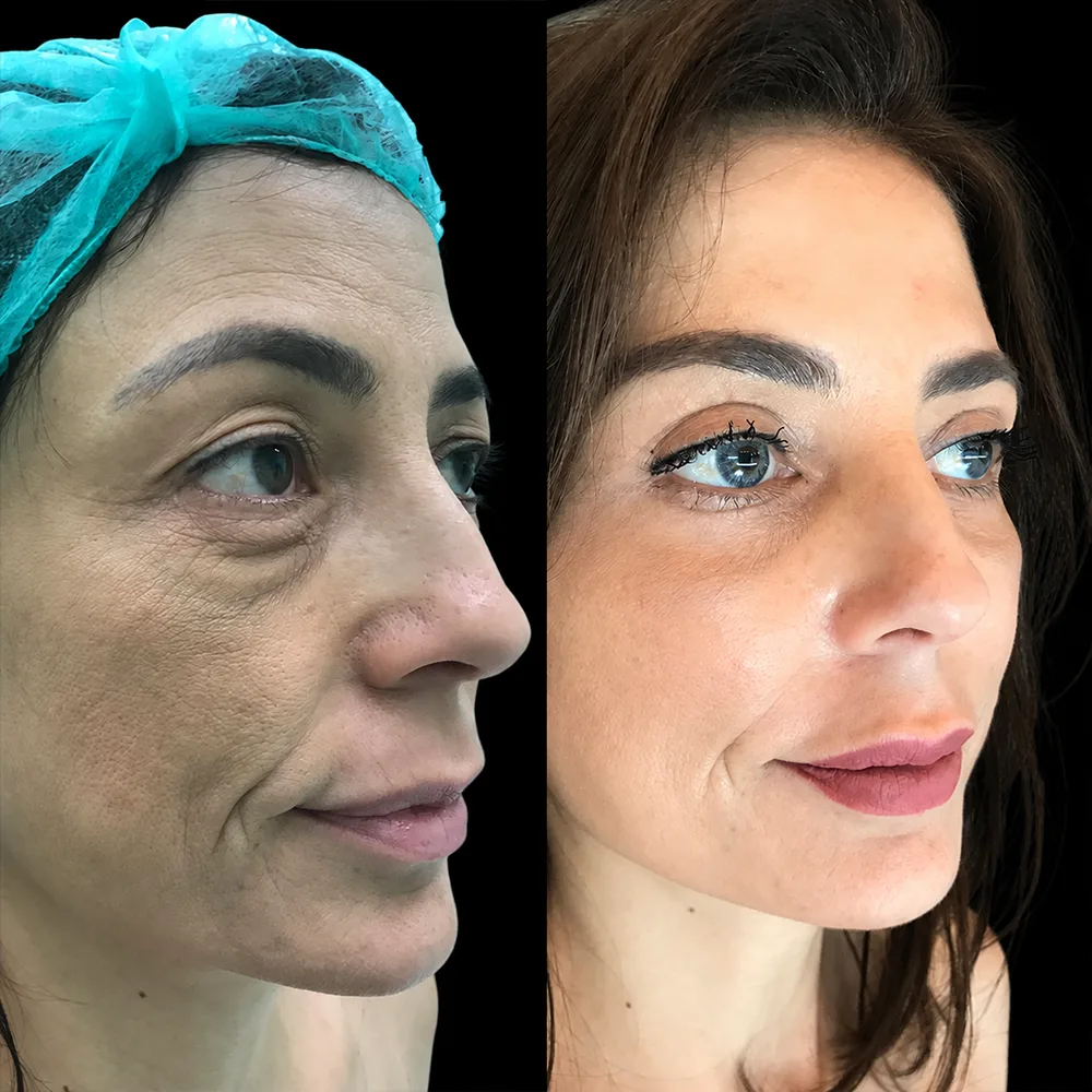 Face and neck lift, before and after, case 01, oblique view