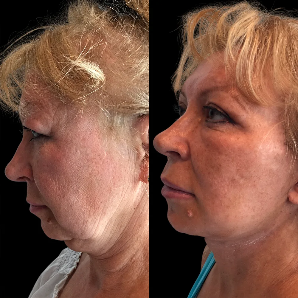 Face and neck lift, before and after, case 05, side view