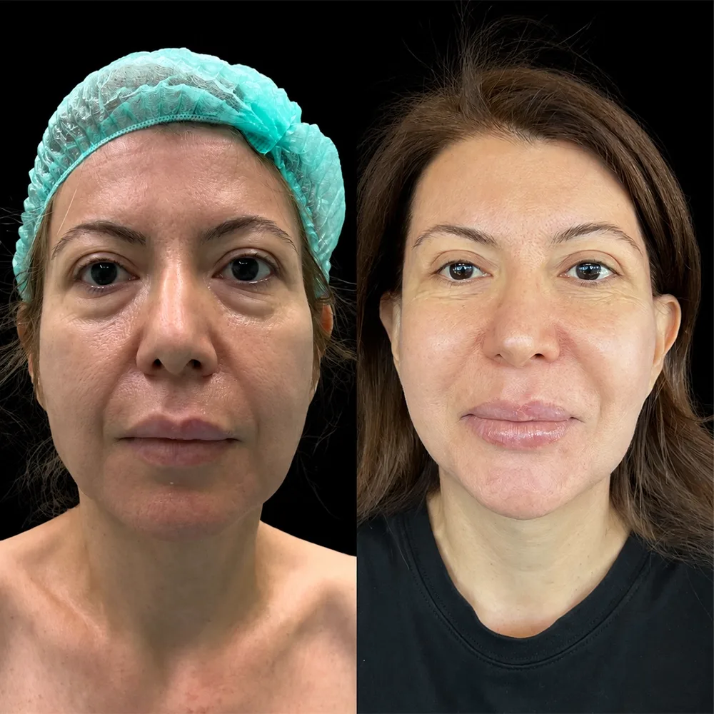 Face and neck lift, before and after, case 12, front view