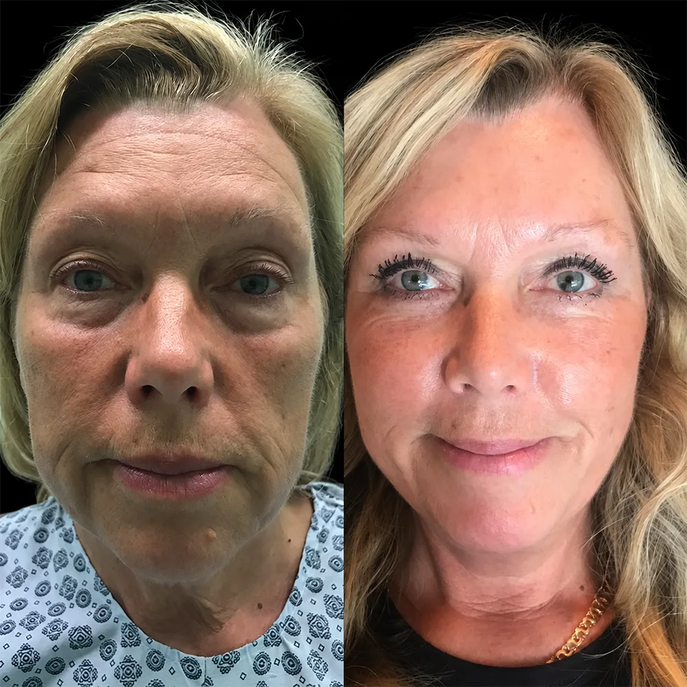 Face and neck lift, before and after