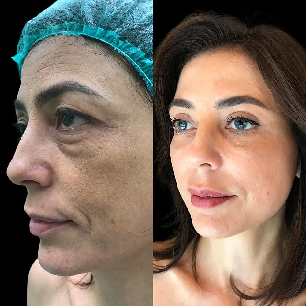 Face and neck lift, before and after, case 01, side view