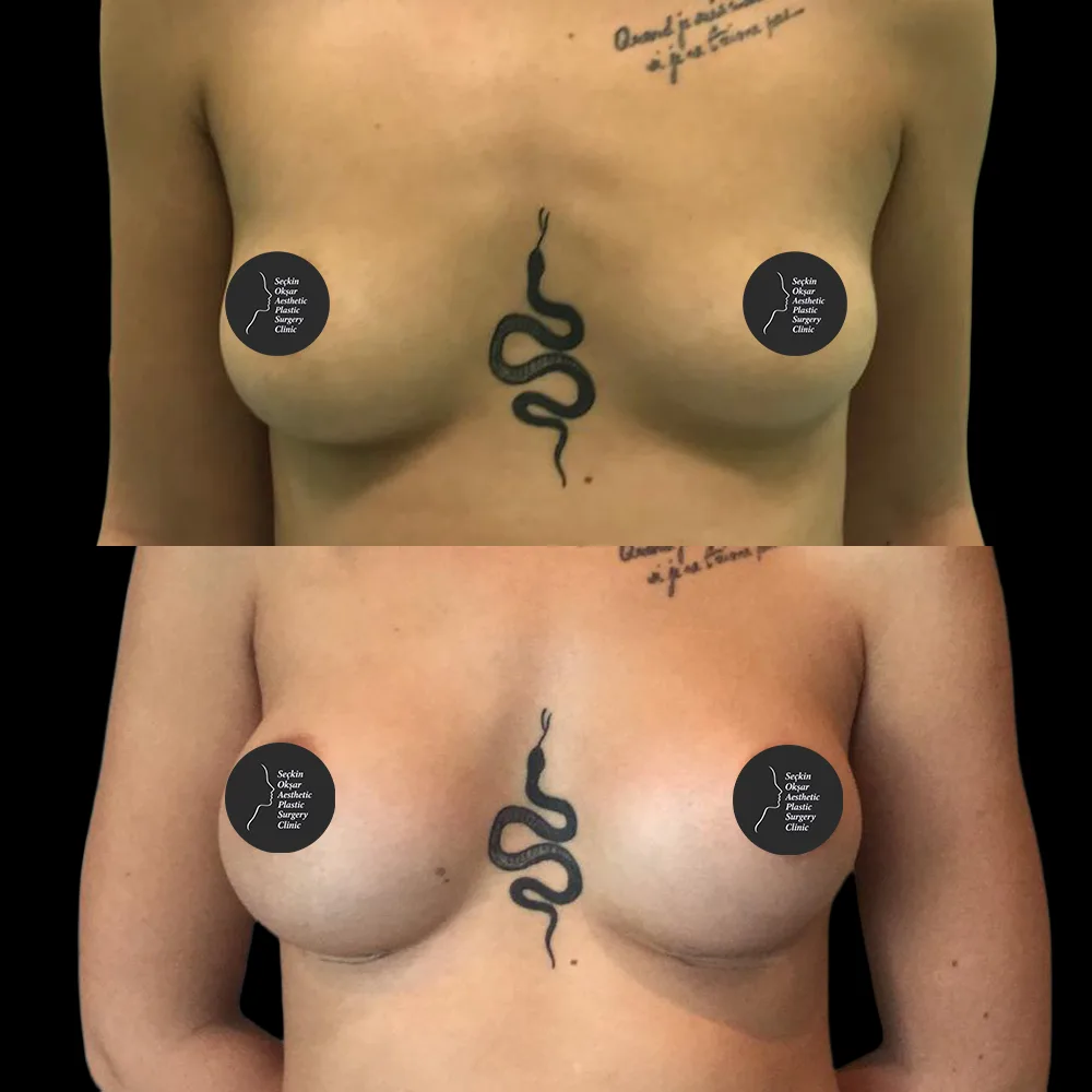 Breast augmentation, before and after, case 08, side view