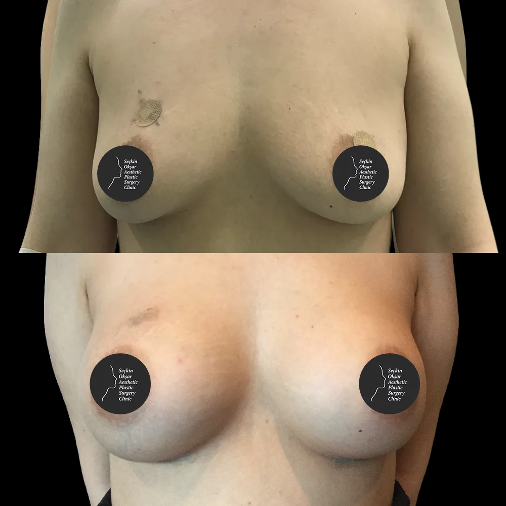 Breast augmentation, before and after, case 02, side view