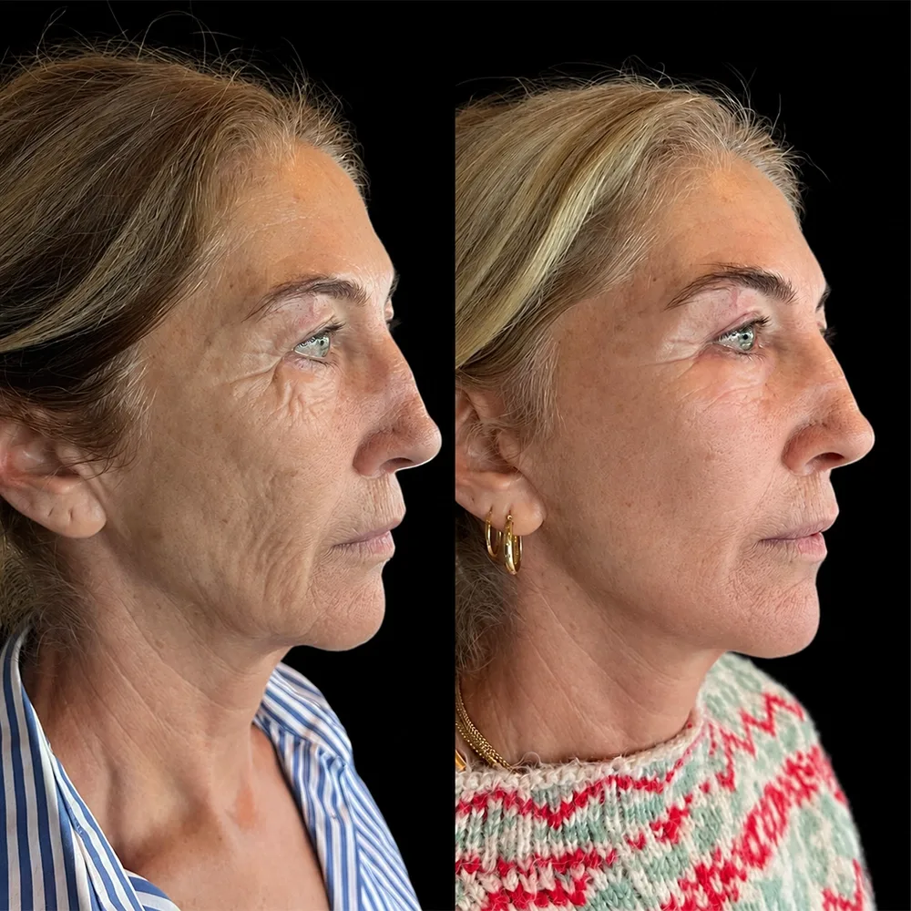 Face and neck lift, before and after, case 13, oblique view