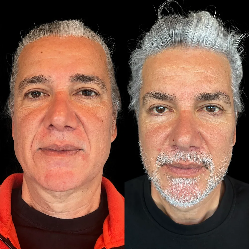 Face and neck lift, before and after, case 10, front view
