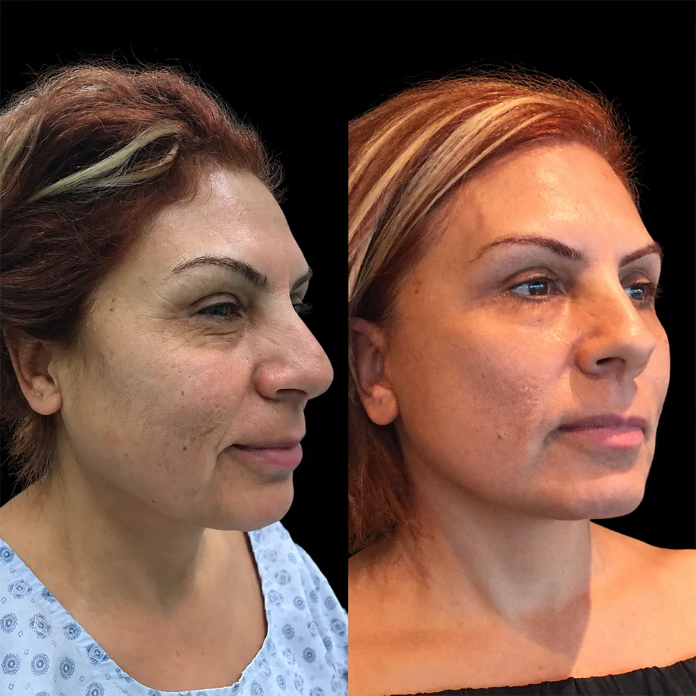 Face and neck lift, before and after, case 04, profile view
