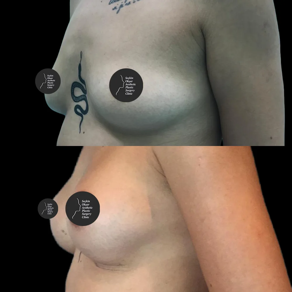 Breast augmentation, before and after, case 09, oblique view