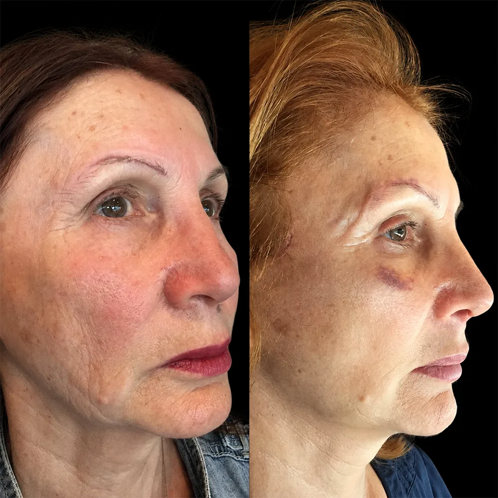 Face and neck lift, before and after, case 06, oblique view