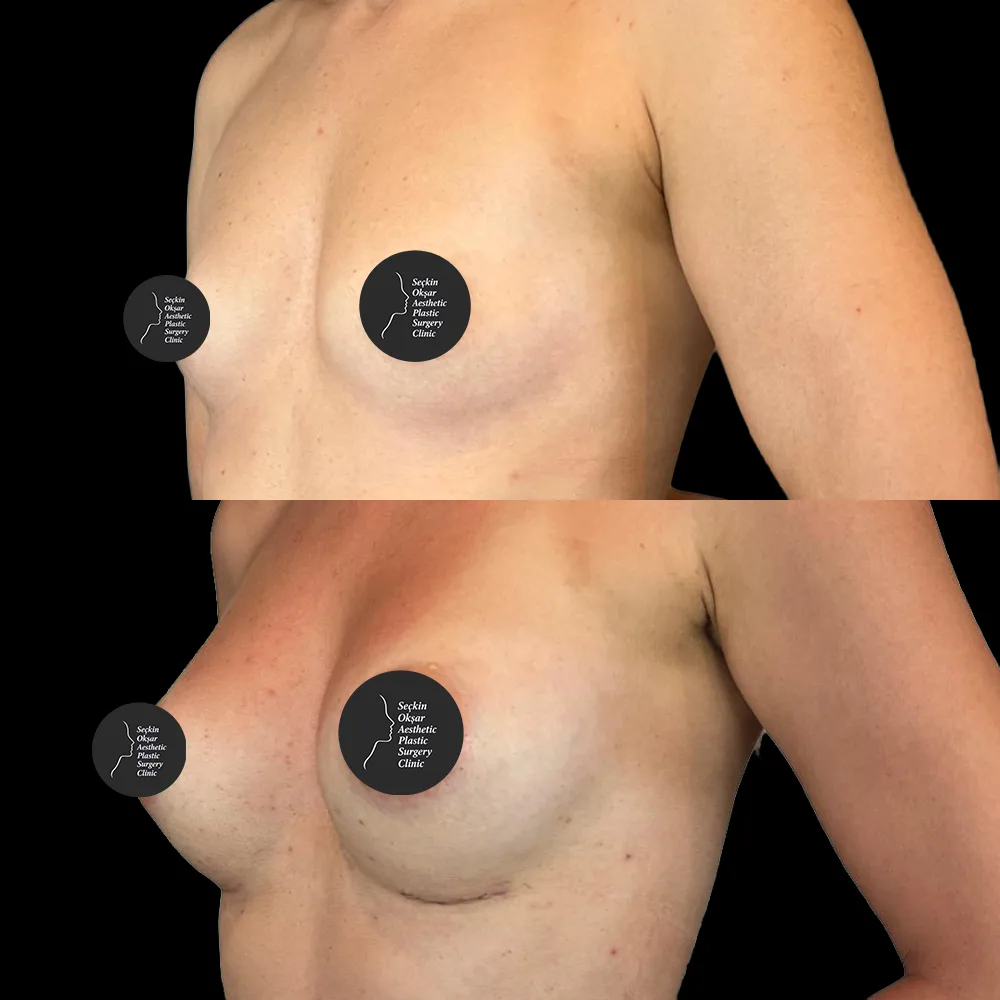 Breast augmentation, before and after, case 01, oblique view
