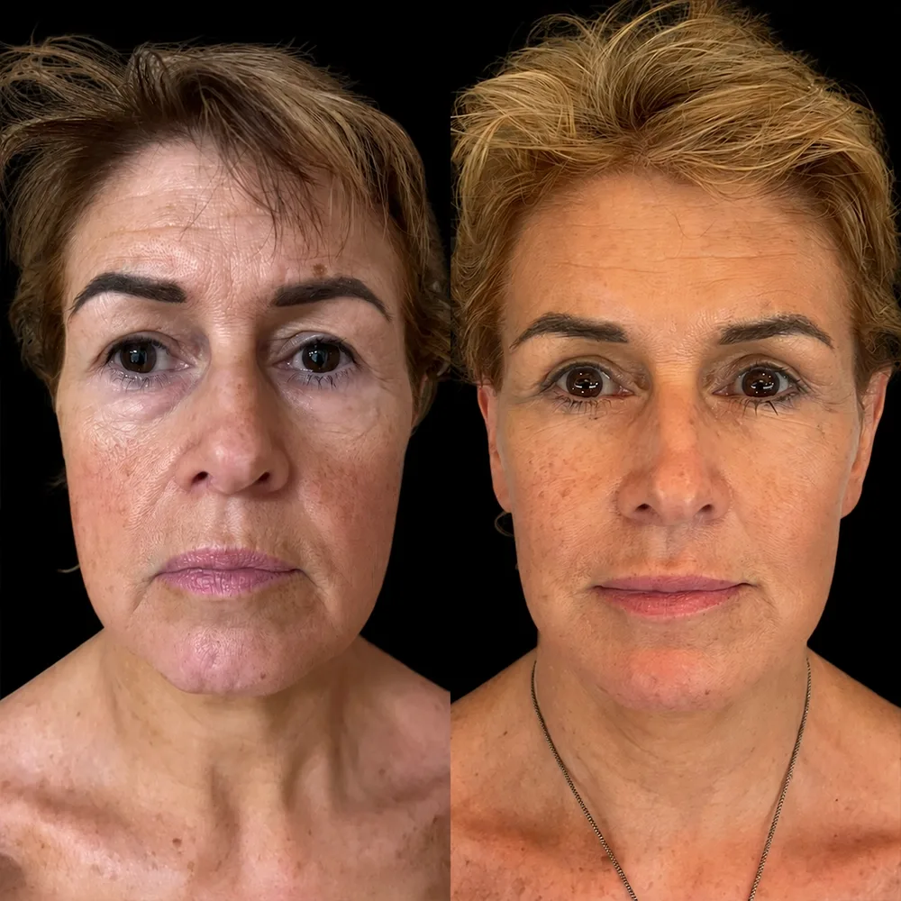 Face and neck lift, before and after, case 09, front view