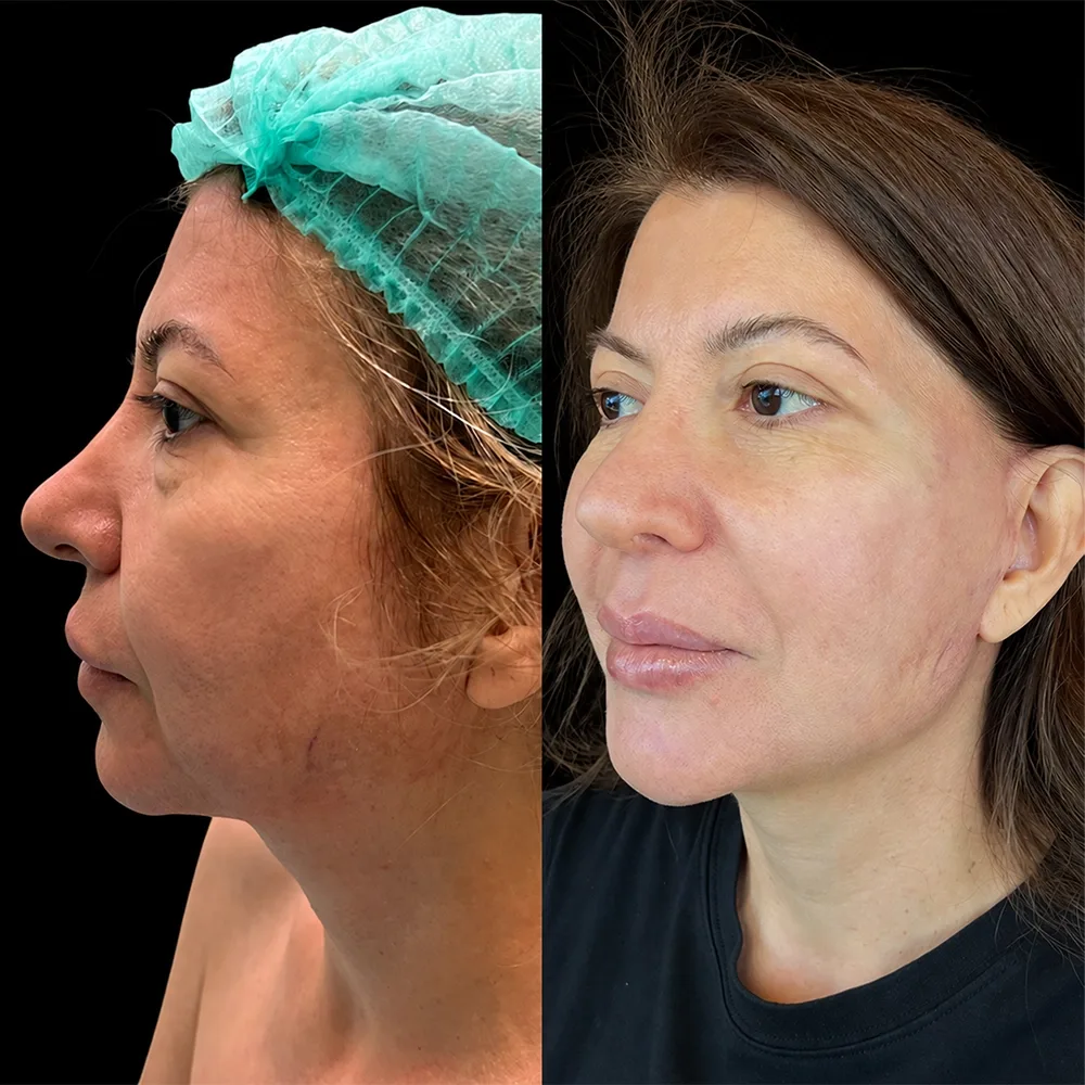 Face and neck lift, before and after, case 12, oblique view