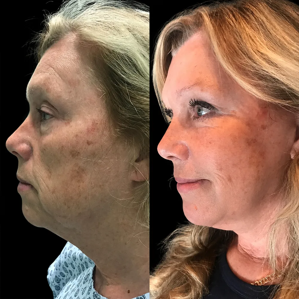 Face and neck lift, before and after, case 02, oblique view