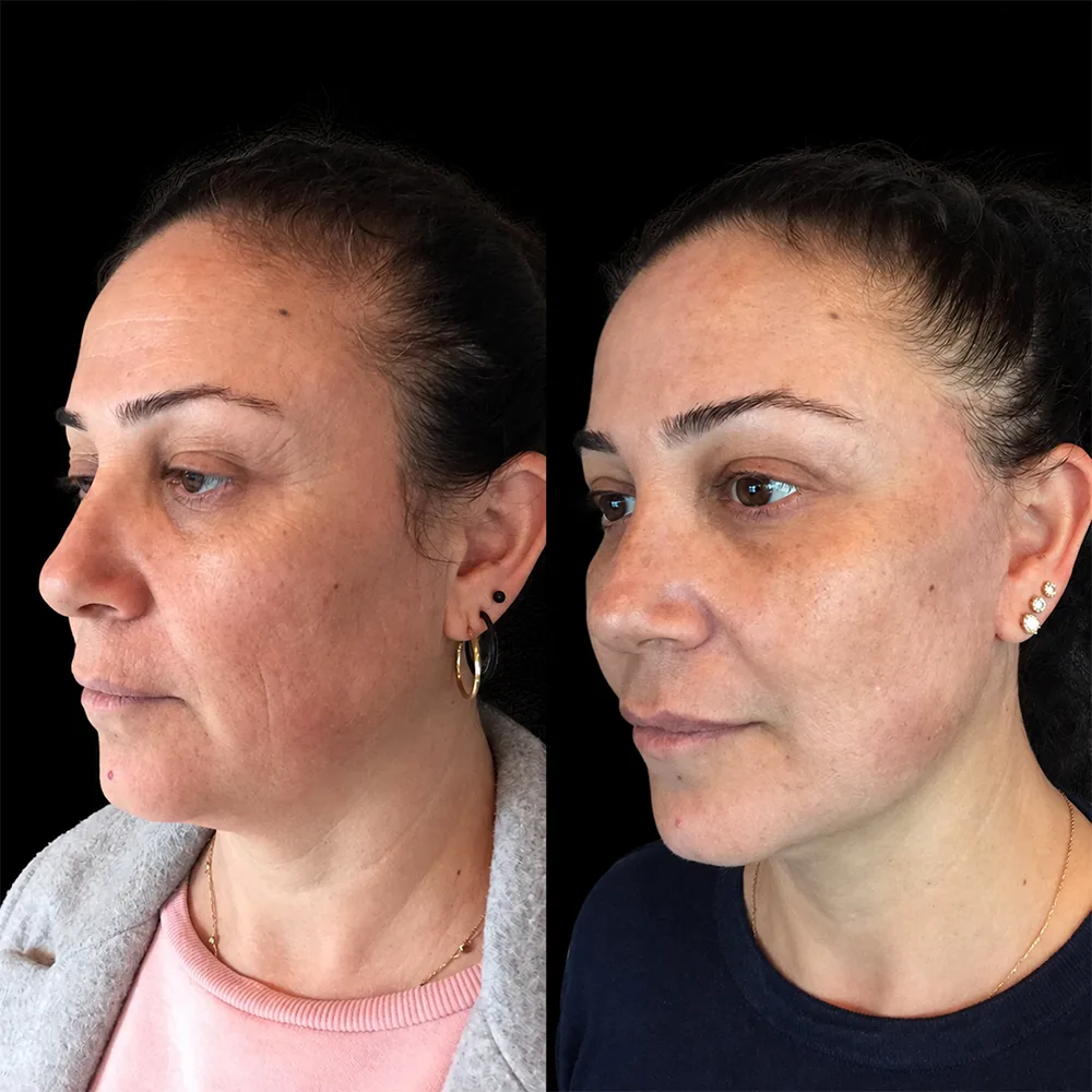Face and neck lift, before and after, case 07, side view