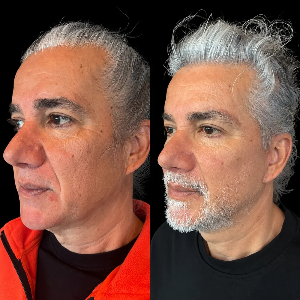 Face and neck lift, before and after, case 10, profile view
