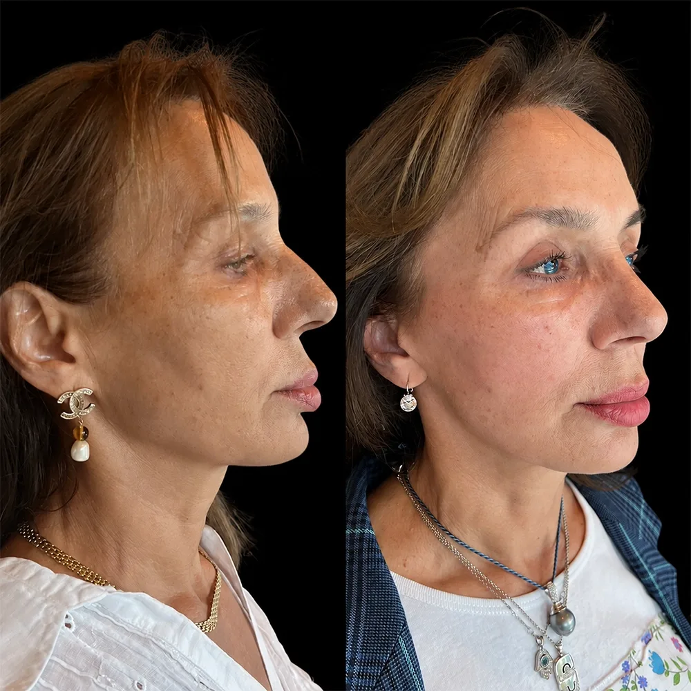 Face and neck lift, before and after, case 16, oblique view