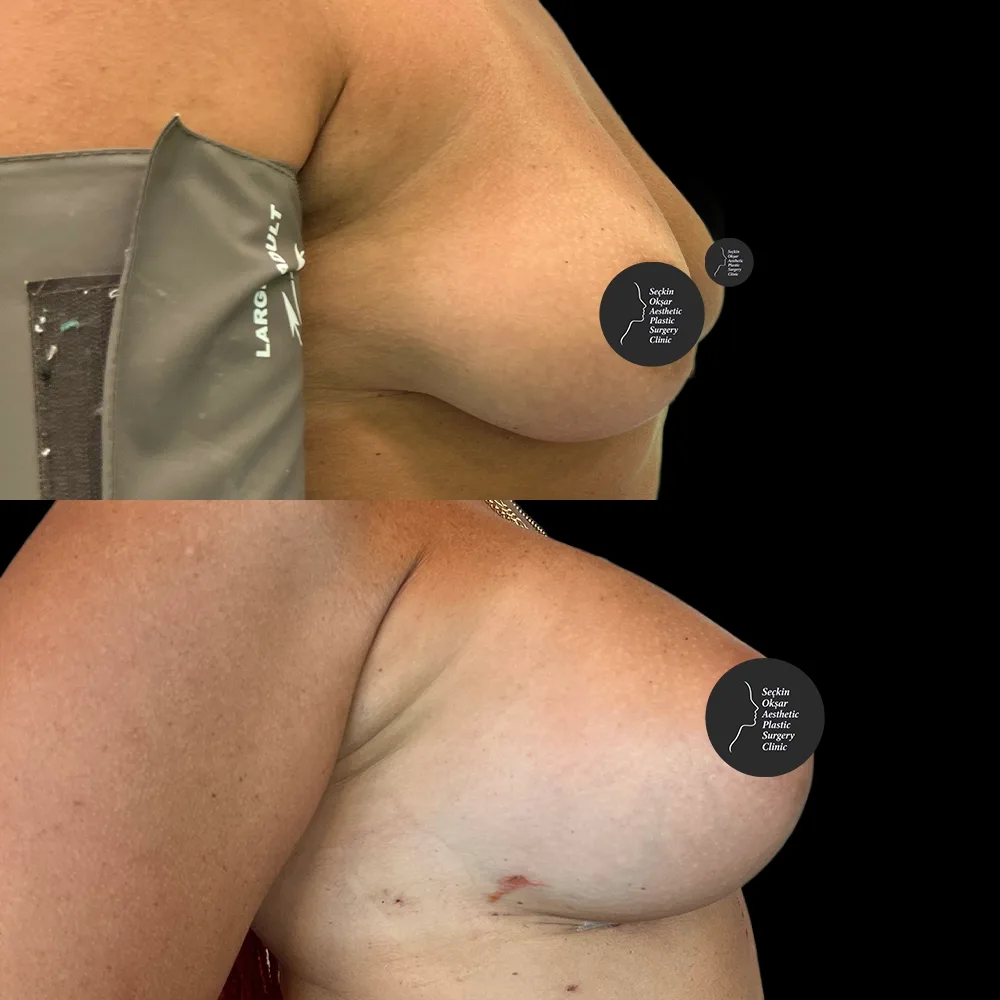 Breast augmentation, before and after, case 12, side view